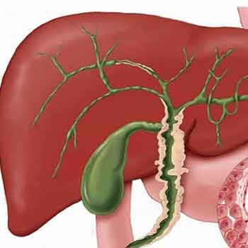 بیماری کلانژیت صفراوی اولیه