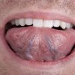 علائم اولیه سرطان زبان چیست؟