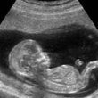 عوارض سونوگرافی جنین
