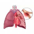 در مورد آمبولی ریه چه میدانید؟