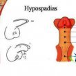 هیپوسپادیاس چیست؟