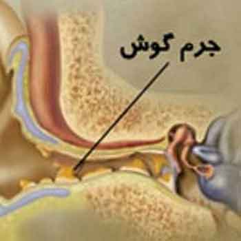 جرم گوش یا سرومن