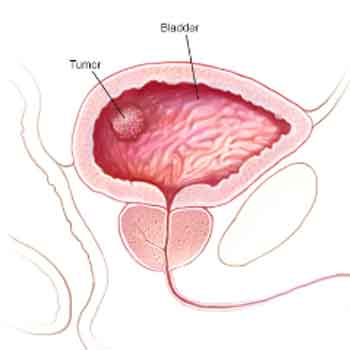 بیماری سرطان مثانه