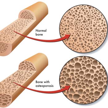 درمان پوکی استخوان چیست؟