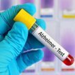 آزمایش خون و تشخیص آلزایمر