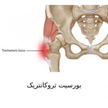 بورسیت تروکانتریک