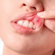 زخم دهان چیست؟